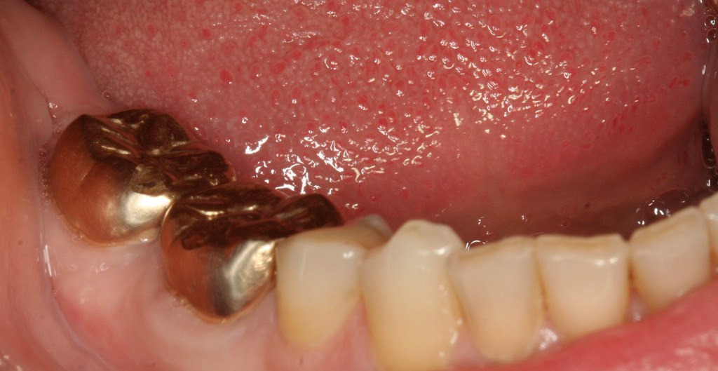 gold tooth crown nhs